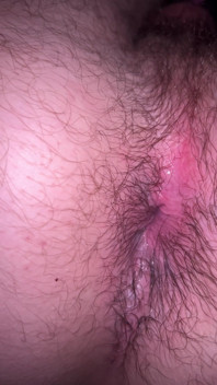 Bruised Asshole