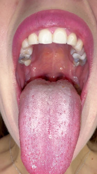 Mouth Secrets: Thick White Coating on My Tongue