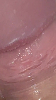 Extreme Burning Sensation Makes the Glans Foam with Arousal.