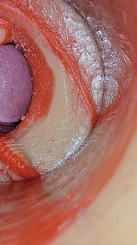 Female Insemination - Internal Camera Captures Deep Male Huge Ejaculation