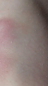 Eu Te Mostro Os Hematomas Nas Minhas Pernas Depois De Sexo