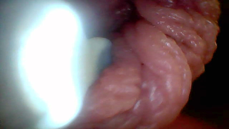 Twittiy: Camera endoscop arată cele mai sensibile părți ale penisului video...