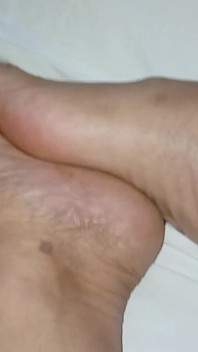 Gresopio en pies masculinos 16
