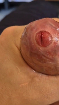 Phimosis papi. Ight vorhaut streicheln, bis ich überall leckt