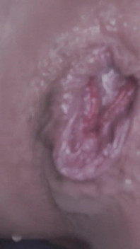 Anal Destruction