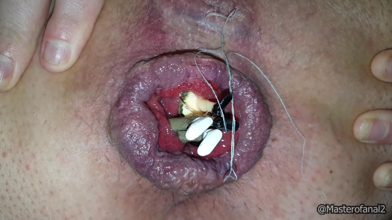 Violet Buttercup: Uriașă anală și pizdă - Speculum și pârțuri