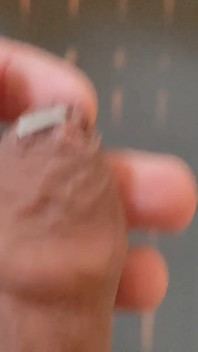 Fimosis Stapling yang sengit