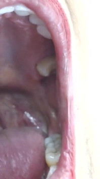 내 큰 입 혀 이빨 이복 누이 Uvula 내부