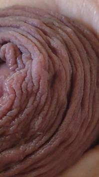 Immense Phimosis Being Extracted Cum and Précum.