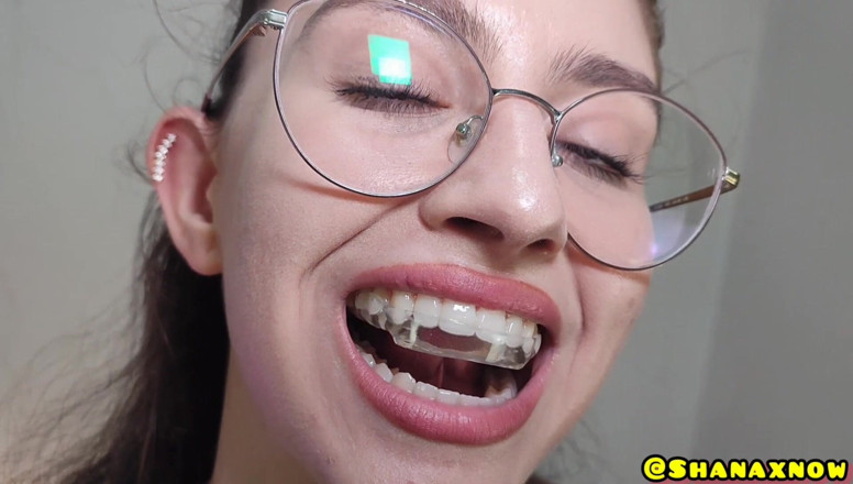 Shanaxnow: My Fetish Orthodontic Retainer Brace Tongue Teeth