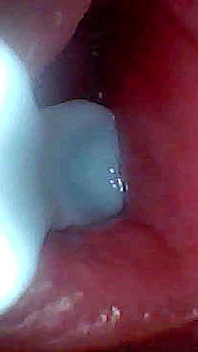 Ich Konnte Nicht Glauben, Was Im Penis Passiert, Während Sperma Passiert (endoskopische Aufnahmen)