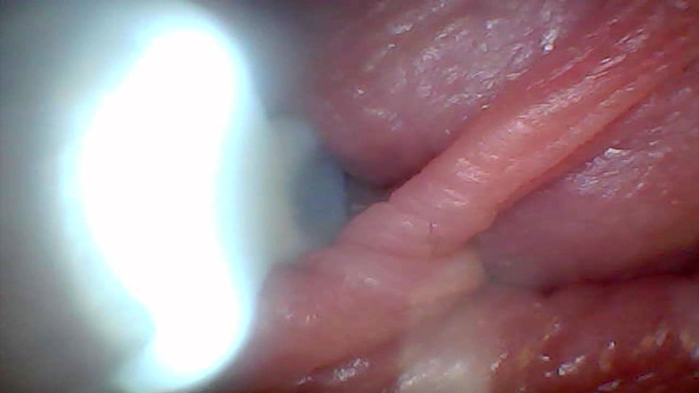 Twittiy: Endoscope Camera Shows the Most Sensitive Parts of the Penis...