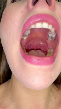 Mouth Secrets: Thick White Coating on My Tongue