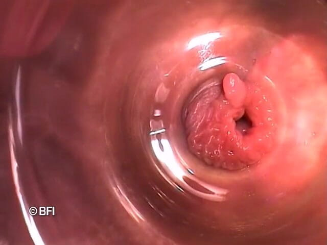 Pegging insertion: Fail pelik 162