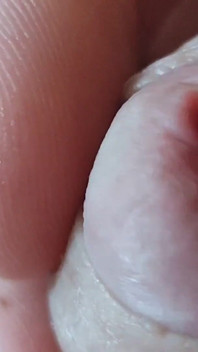 Extreme Open Hole Leaves the Glans Exposed.