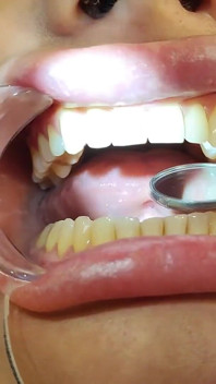Esame completo dei denti dal dentista, Installazione di gioielli
