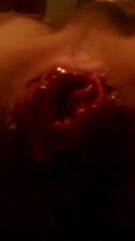 Video Prolaps dubur pertama saya yang saya rakam