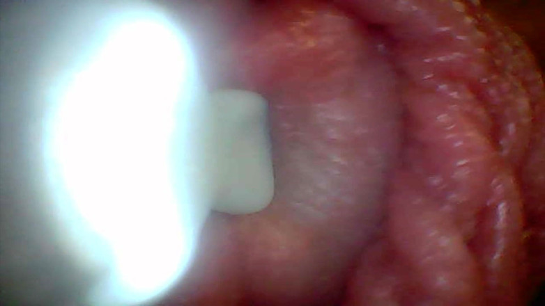 Twittiy: Endoscope Camera Shows the Most Sensitive Parts of the Penis...