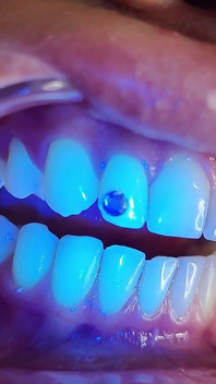 Complete Teeth Exam by the Dentist, Installation of Jewelry