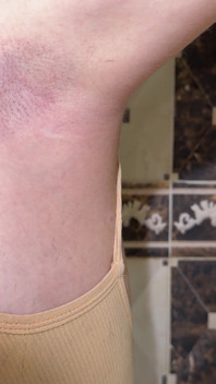 Depilando axilas peludas! Depilação! Depilação de axilas com um depilador!