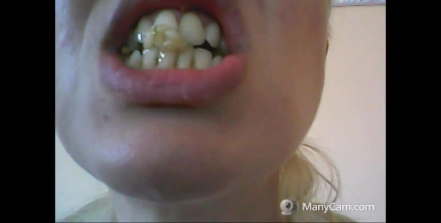 savannahamatoriale: I denti di chantal cadono a pezzi, marcio e nero