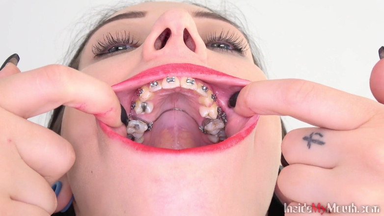 Inside My Mouth: Fetysz ustny wideo z Barą pokazującą aparaty ortodontyczne.