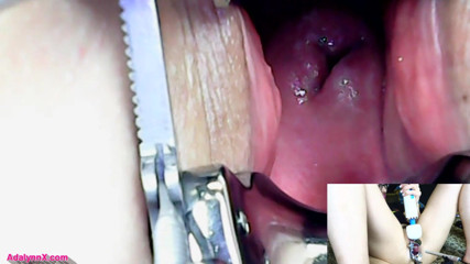 AdalynnX: AdalynnX - speculum endoscope hitachi vib