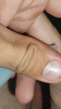 Inserting the Super Glue Through the Boy's Glans.