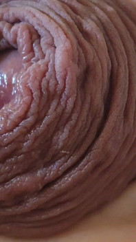 Immense Phimosis Being Extracted Cum and Précum.