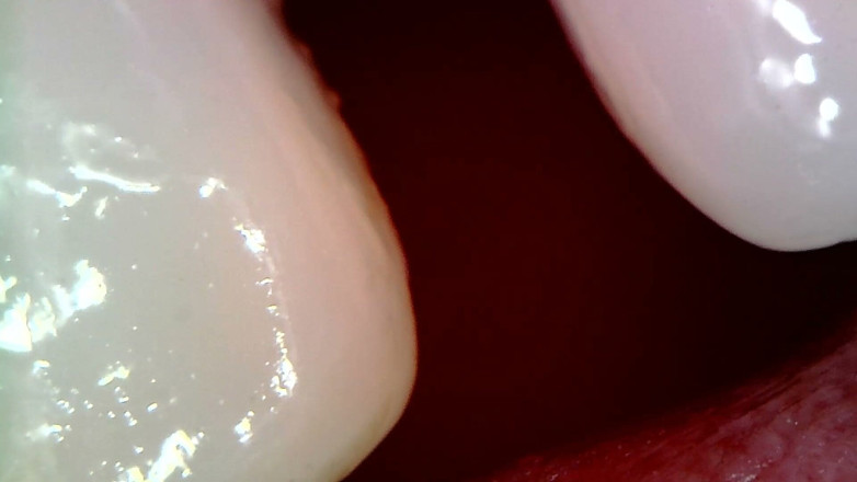 Nicoletta Embassi: Examen Oral Endoscopio Médico: Masticación De Encía, Dientes Extremos Y...