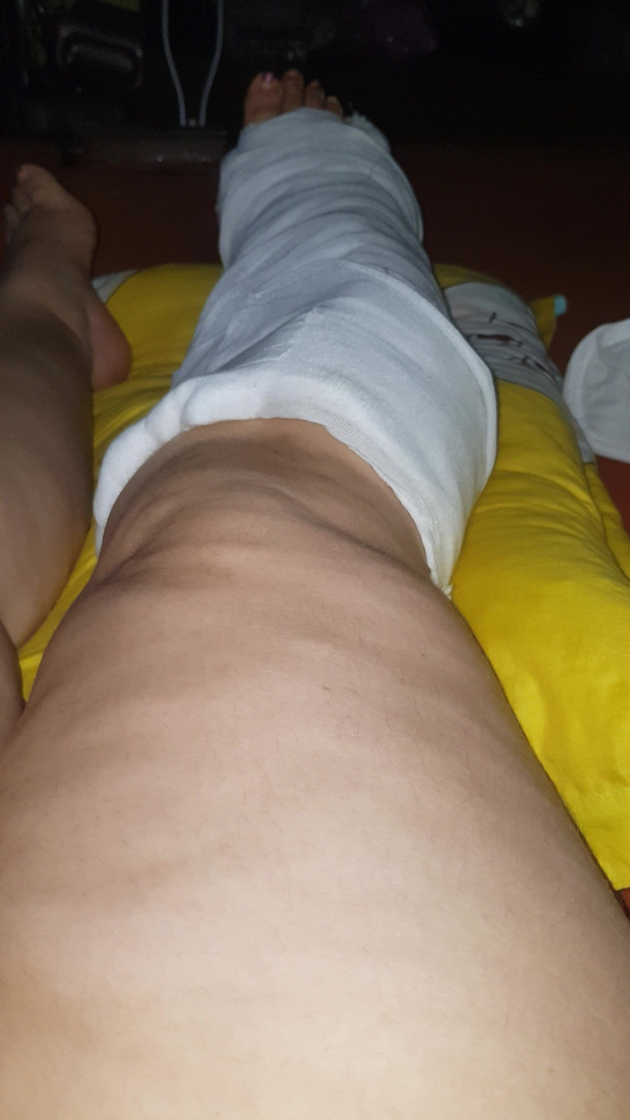 LoraBbw: Wiggling My Toes in Cast