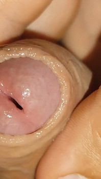 Difficult Fluid Control Due to Straight Phimosis.