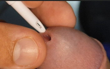 Straight Daddy Club: 先のとがったストローの亀頭への極端な挿入。