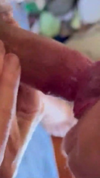 Eu fiz cirurgia lombar nas costas, e essa foi a minha foda de recuperação