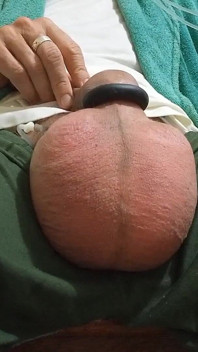 Saline in the Testicles