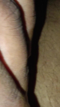 Urine Infection