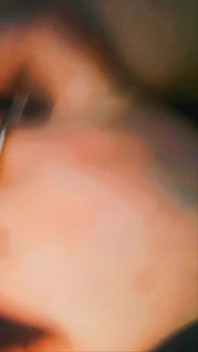 Solotease
