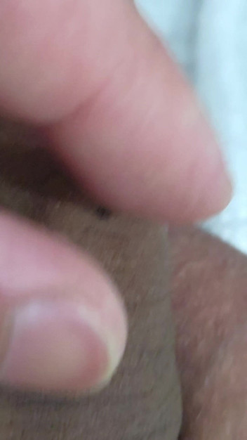 Lkdick8: 私のペニスのこれらの斑点は何ですか