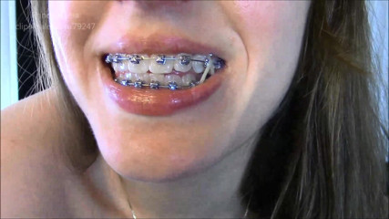 Princess Leia: Embracing Braces