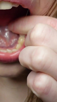 Ich Erzähle Ihnen Über Die Füllungen in Meinen Zähnen Und Zahnbesuchen