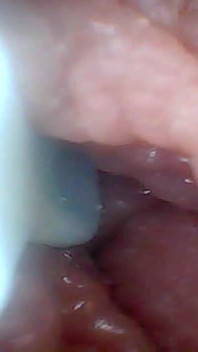 内窥镜摄像头显示阴茎教育视频中最敏感的部分
