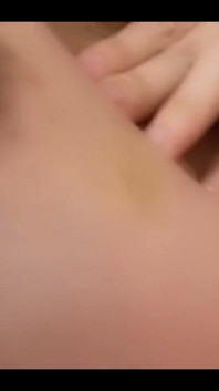 Bruise on Tits Update