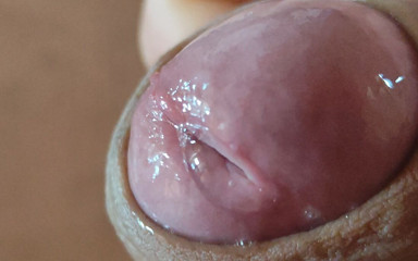 DaddyDoted: Una Crepa Profonda Nel Glande Produce Liquido Bollente.