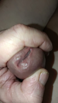 Is My Meatus Open?