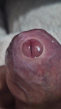 Neobřezaná Těsná phimosis péro předkožka natažená zblízka