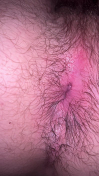 Bruised Asshole