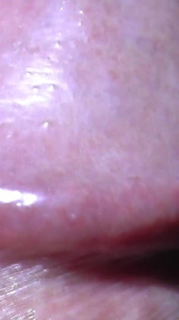 Tayson's glands or pearly papules