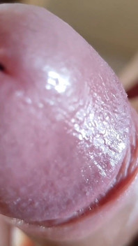 Opening the Scar of the Rough Frenulum!
