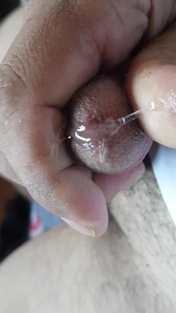Alejandro Vazquez Flores: Permainan ureteral 2