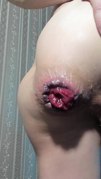 Urethral Prolapse and Anal Prolapse in One Video Xd